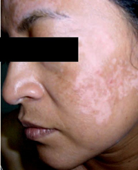 VITILIGO TRATAMIENTO