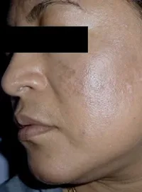 Microfototerapia para vitiligo localizado