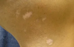 VITILIGO TRATAMIENTO
