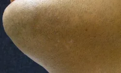 Microfototerapia para vitiligo localizado