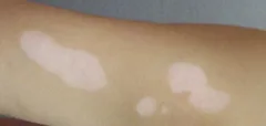 VITILIGO TRATAMIENTO