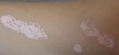 Microfototerapia para vitiligo localizado