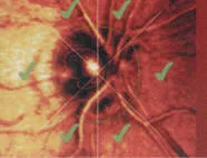 Detección temprana del glaucoma - Guayaquil - Ecuador - CENTRO DE DIAGNOSTICO OCULAR