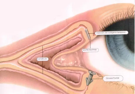 Imagen del artículo Sufre Usted de ojo seco?