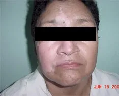 Vitiligo, todo lo que debe saber