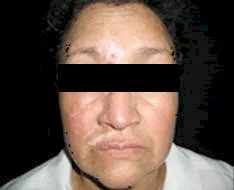 Vitiligo, todo lo que debe saber