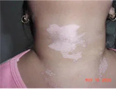 Vitiligo, todo lo que debe saber