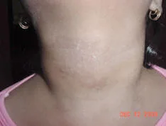Vitiligo, todo lo que debe saber