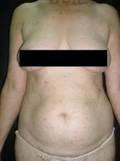 Imagen del artículo Pitiriasis liquenoide
