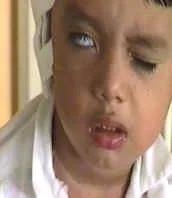 Imagen del artículo Parálisis facial periférica