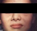 Parálisis facial periférica