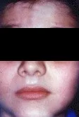 Parálisis facial periférica