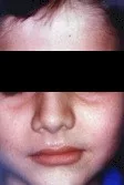 Parálisis facial periférica