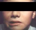 Parálisis facial periférica