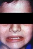Parálisis facial periférica