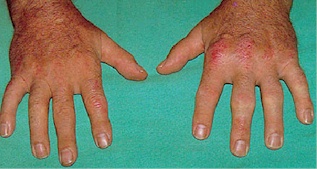ARTRITIS PSORIASICA