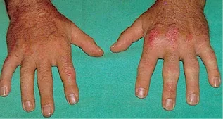 Imagen del artículo Artrítis Psoriásica