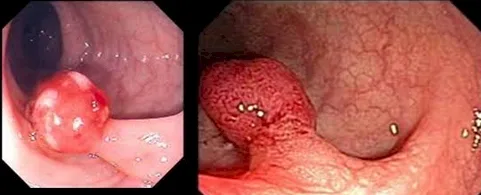 Imagen del artículo Pólipos del colon