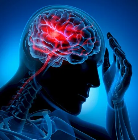 Imagen del artículo El accidente cerebrovascular o derrame cerebral un asesino silencioso y olvidado