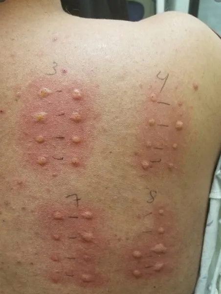 Imagen del artículo Alergia y polisensibilizaci?