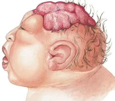 Imagen del artículo Qué es la anencefalia ?