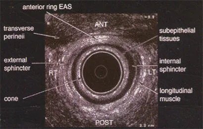 Imagen del artículo Anatomía Normal del Canal Anal visto a través de endosonógrafo
