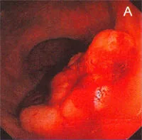Anatomia normal del Canal Anal visto a traves de endosonografia