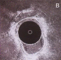 Anatomia normal del Canal Anal visto a traves de endosonografia