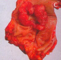 Anatomia normal del Canal Anal visto a traves de endosonografia