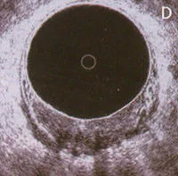 Anatomia normal del Canal Anal visto a traves de endosonografia