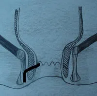 Anatomia normal del Canal Anal visto a traves de endosonografia