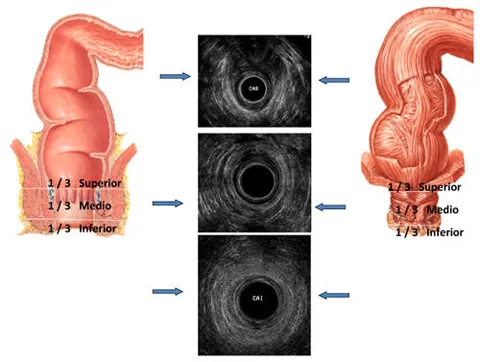 Anatomia normal del Canal Anal visto a traves de endosonografia