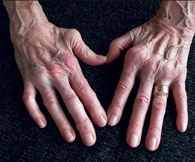 Imagen del artículo Artritis reumatoide