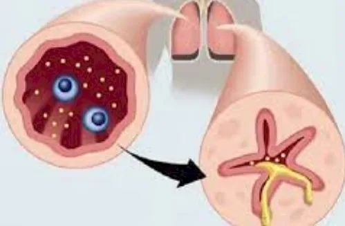 Imagen del artículo El asma bronquial, epidemia mundial
