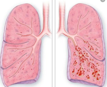 Bronquiectasia