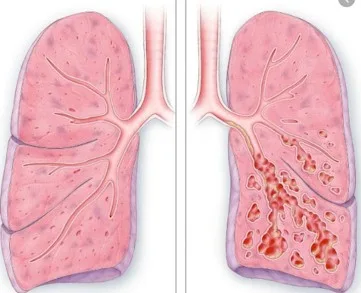 Imagen del artículo Bronquiectasia