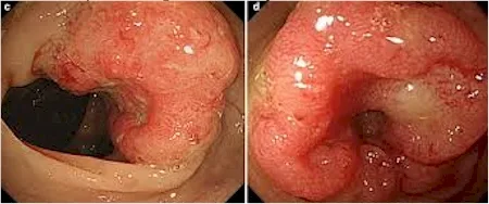 cáncer de estómago
