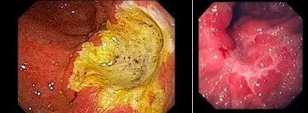 cáncer de estómago