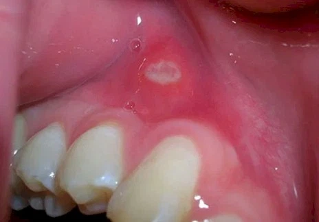 Imagen del artículo CANCER ORAL