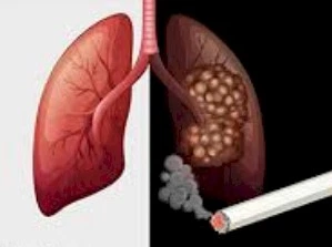 Imagen del artículo Factores de Riesgo en cáncer de Pulmón