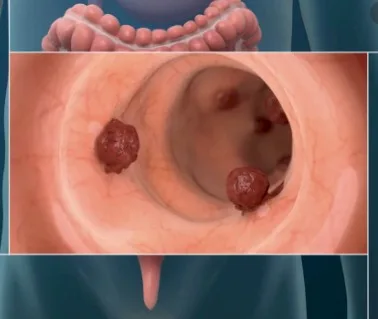 Imagen del artículo El cáncer de colon