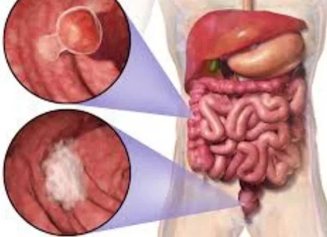 Cáncer colo-rectal y pólipos del colon y recto