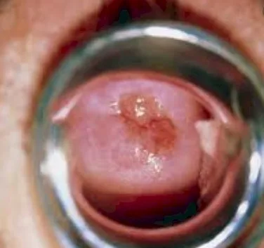 Imagen del artículo El cáncer de Cuello de Útero si se puede evitar