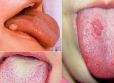 Imagen del artículo CANCER DE LENGUA