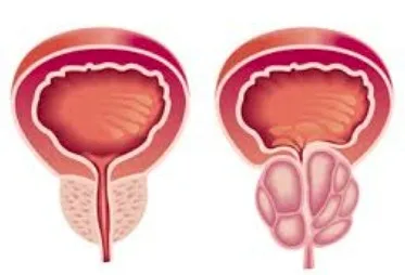 Imagen del artículo cáncer de Próstata