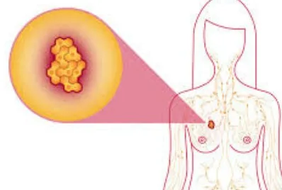 Imagen del artículo El cáncer de seno