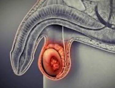 Imagen del artículo El cáncer testicular