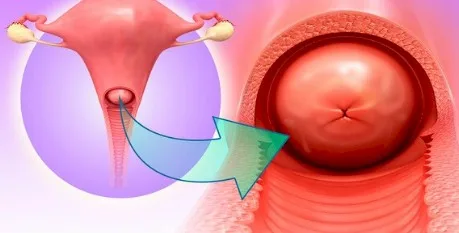 Imagen del artículo El cáncer de Cérvix o cuello uterino