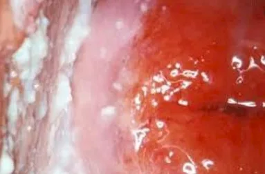 Imagen del artículo Candidiasis vaginal recurrente