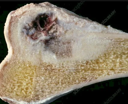 Imagen del artículo cáncer de huesos